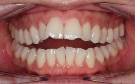 7 typov úsmevov, ktoré ľahko zachráni zubný strojček INVISALIGN. Ktorý je ten váš? 