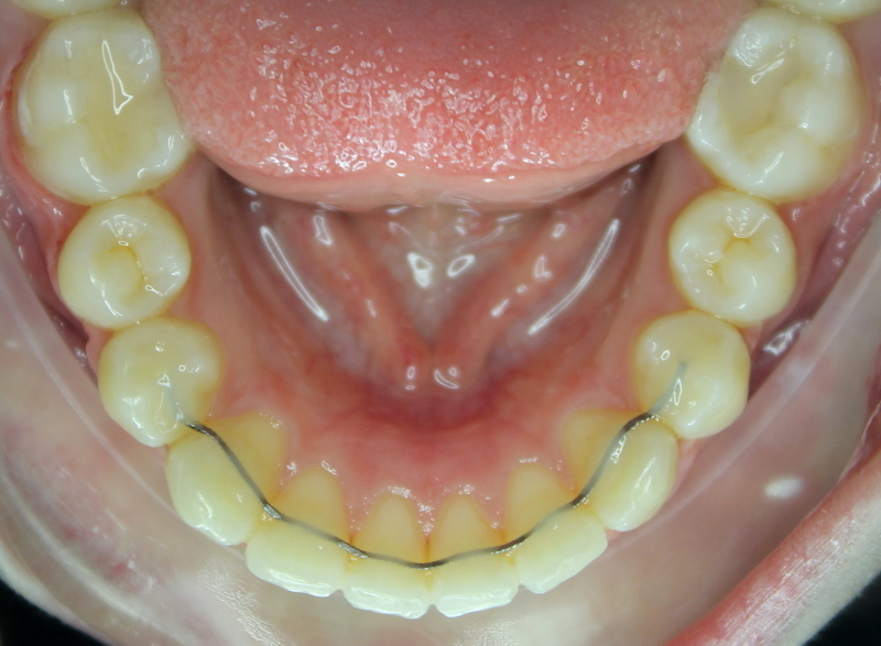 7 KROKOV K ROVNÝM ZUBOM S NEVIDITEĽNÝM APARÁTOM INVISALIGN  