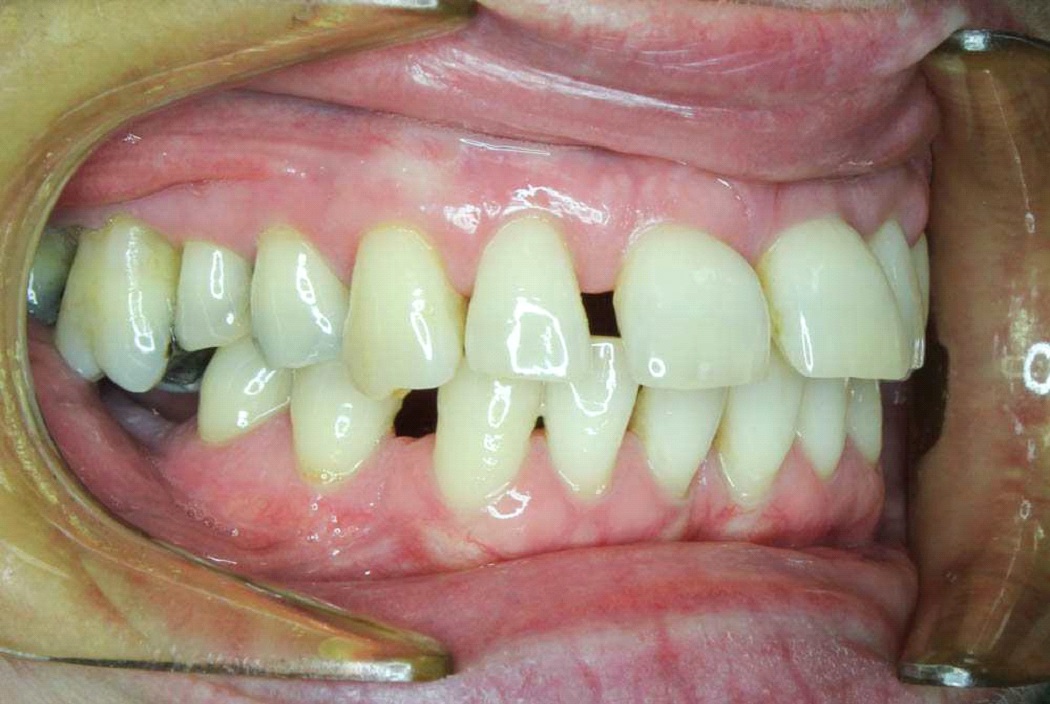 7 typov úsmevov, ktoré ľahko zachráni zubný strojček INVISALIGN. Ktorý je ten váš? 