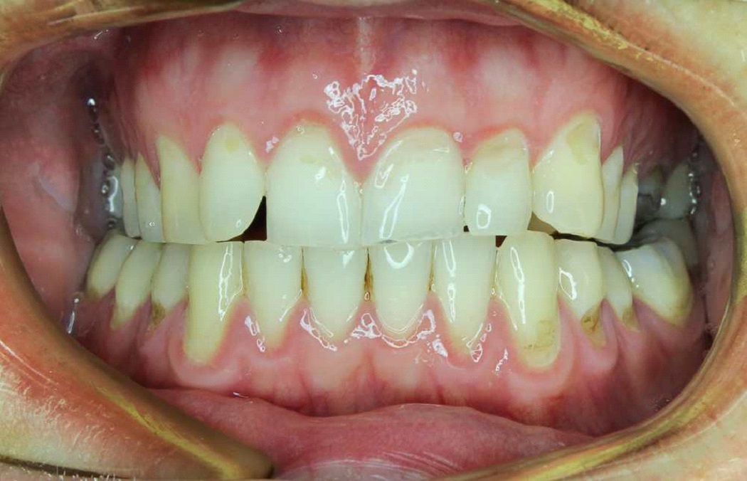 7 typov úsmevov, ktoré ľahko zachráni zubný strojček INVISALIGN. Ktorý je ten váš? 