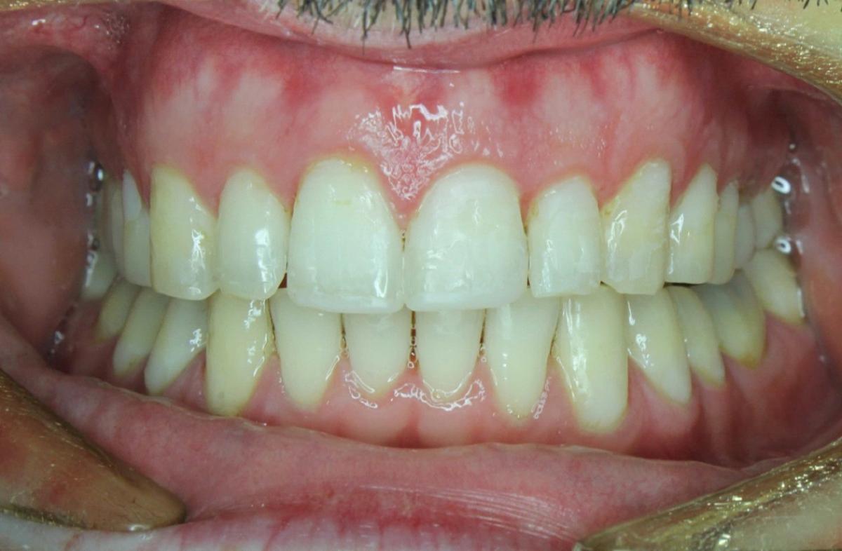 7 typov úsmevov, ktoré ľahko zachráni zubný strojček INVISALIGN. Ktorý je ten váš? 