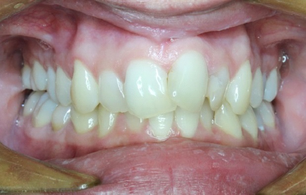 7 typov úsmevov, ktoré ľahko zachráni zubný strojček INVISALIGN. Ktorý je ten váš? 