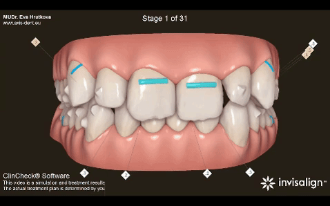 4 dôvody, prečo neviditeľný strojček vyhráva nad klasickým