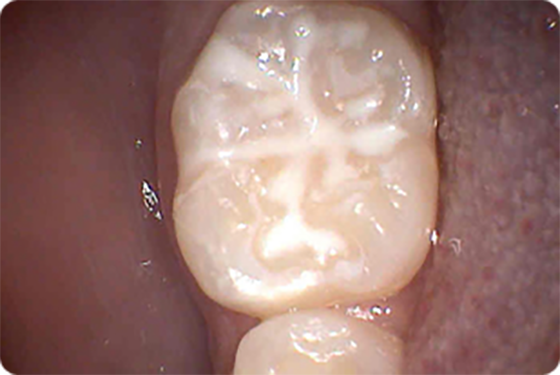 detské zuby - pečatenie