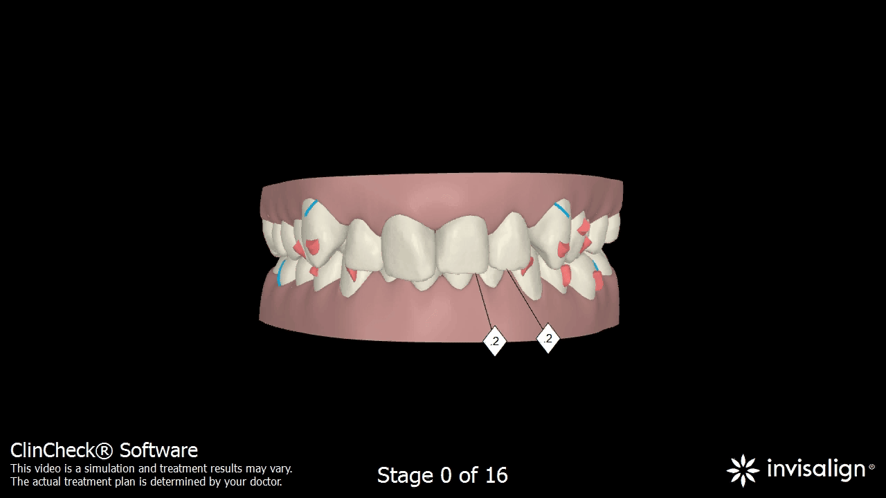 Vizualizácia - pohyb zubov aparátom INVISALIGN