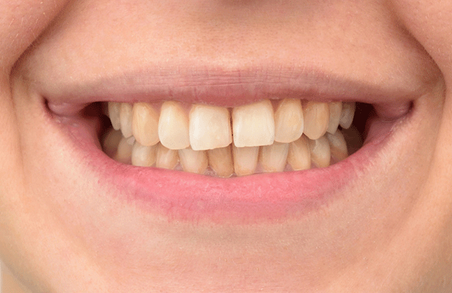 Zuby sfarbené tabakom