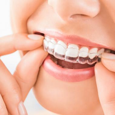 8 kérdés és válasz az Invisalign-nal való mindennapokról